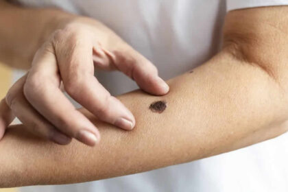 Detecta a tiempo: 5 señales de alerta del cáncer de piel